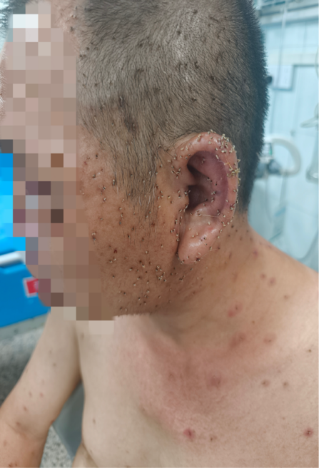 出门散个步,他被近千根毒刺围住……