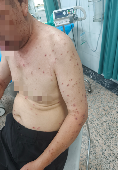 出门散个步,他被近千根毒刺围住……
