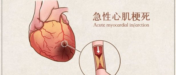 【聚焦临床前沿190】这种心梗更凶险，症状隐匿易漏诊！ECMO+中西医协同，成功救治高危右冠脉心梗休克患者