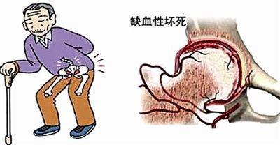 【人医科普】大腿根隐隐作疼别硬扛！警惕股骨头坏死找上门