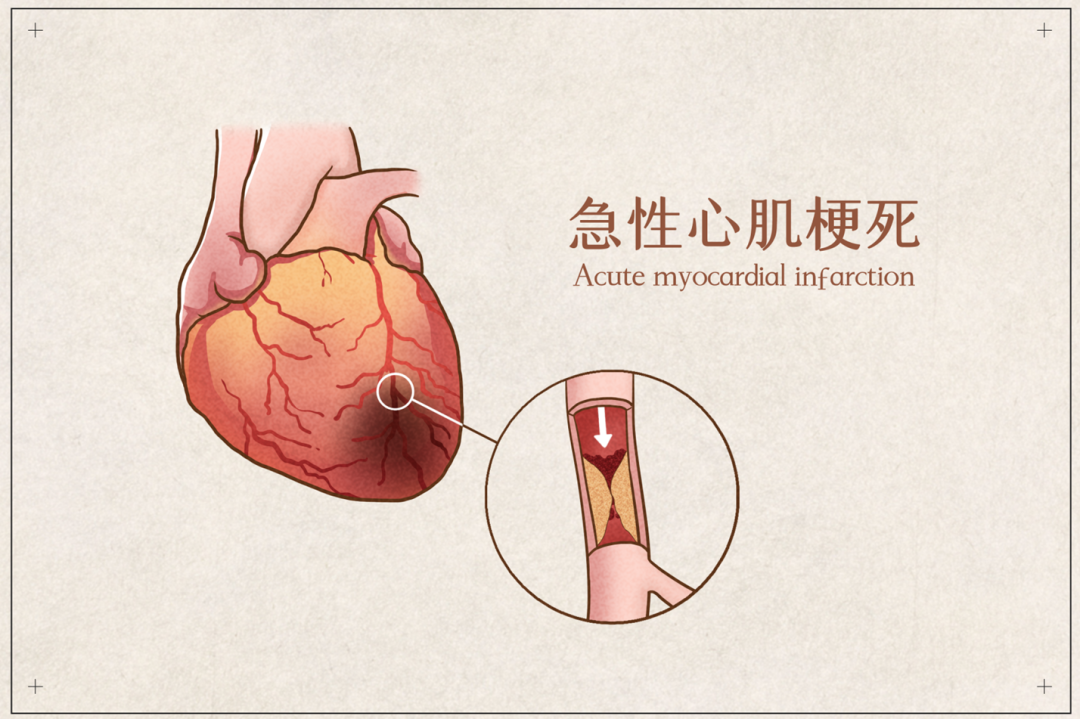 【聚焦临床前沿190】这种心梗更凶险，症状隐匿易漏诊！ECMO+中西医协同，成功救治高危右冠脉心梗休克患者