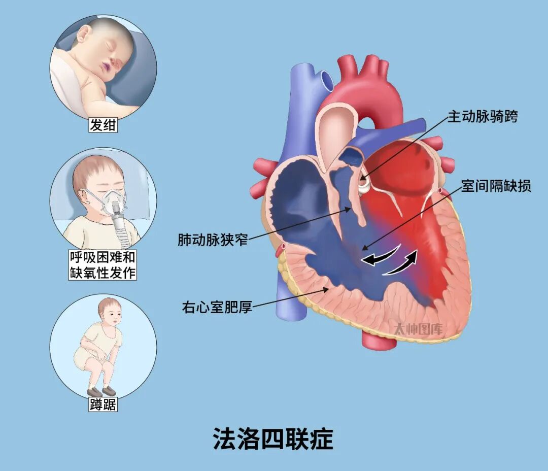 公益|揪心!1岁宝宝一哭就缺氧发紫,爱心助力重获“心”生
