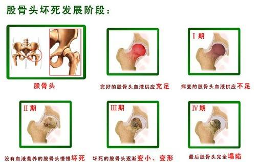 【人医科普】大腿根隐隐作疼别硬扛！警惕股骨头坏死找上门