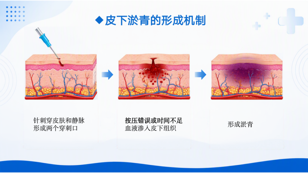 抽血完手臂淤青?原来是按压出了错