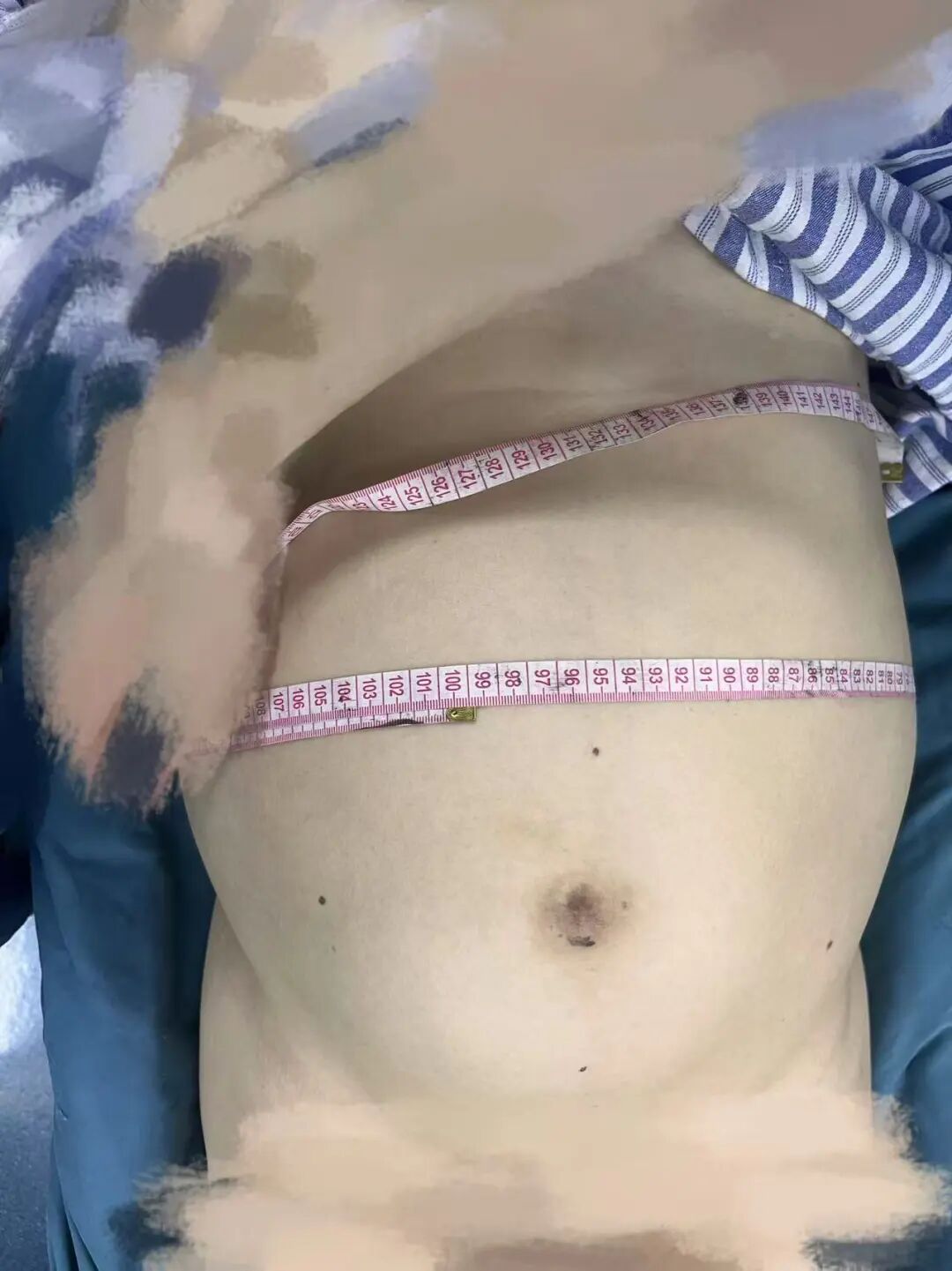 49 岁女子体内取出 16 斤肌瘤,早期信号别忽视