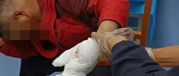 突破救治极限！西藏阜康医院骨科团队成功完成高难度断指再植手术，奇迹“复活”中指！