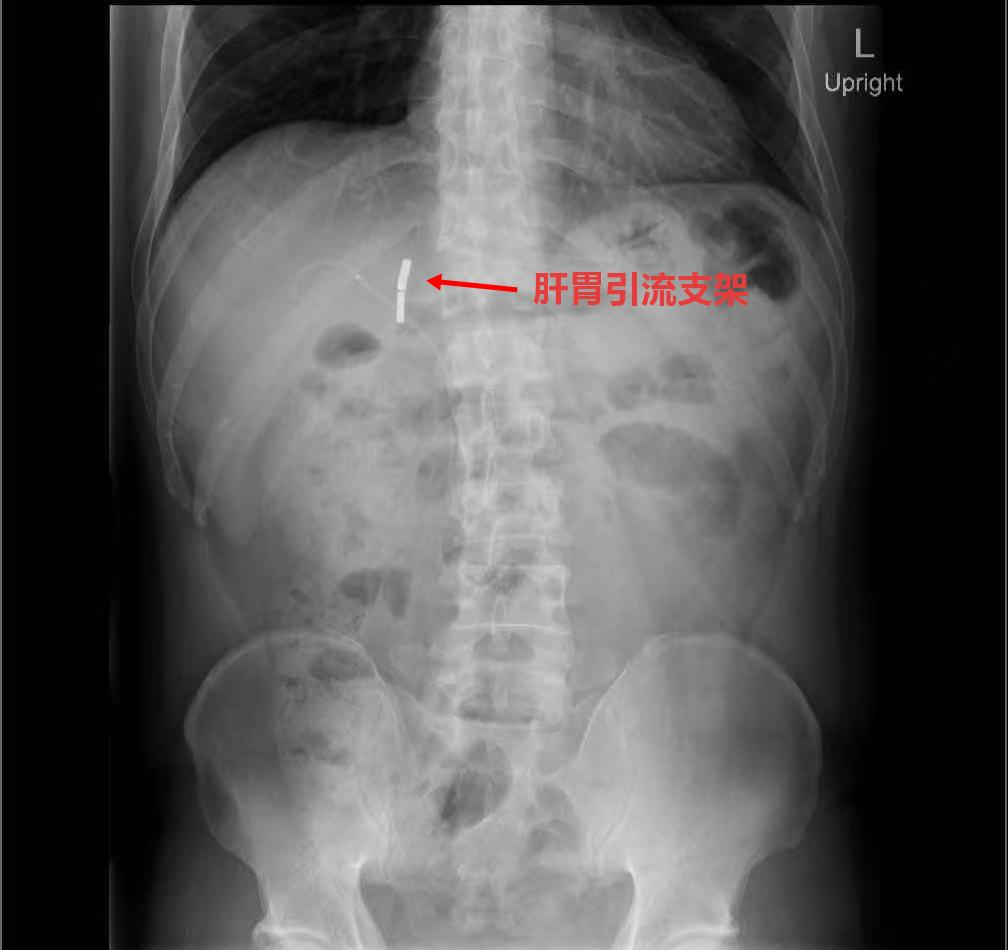 交医精术|肝胆外科团队联合EUS-BD、ERCP成功打通肝门部闭锁胆道