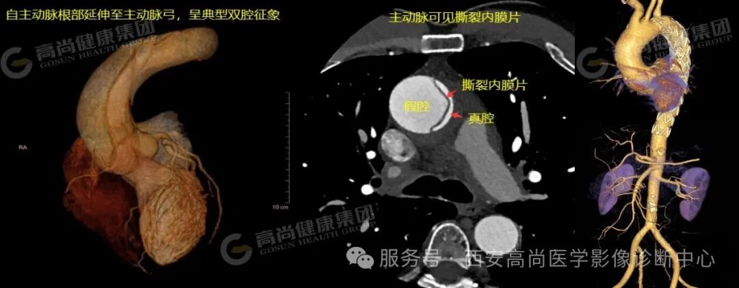 为什么医生建议你做一次全身血管CTA检查?
