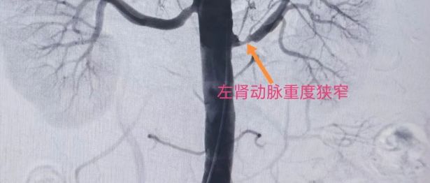 降压药吃了不少，血压仍居高不下，警惕肾动脉狭窄这个隐形元凶