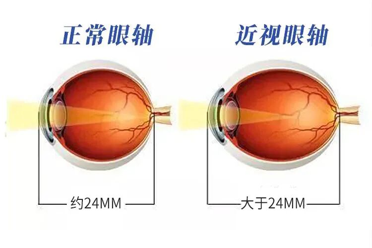 高度近视想做激光手术？先看这几个数据符不符合