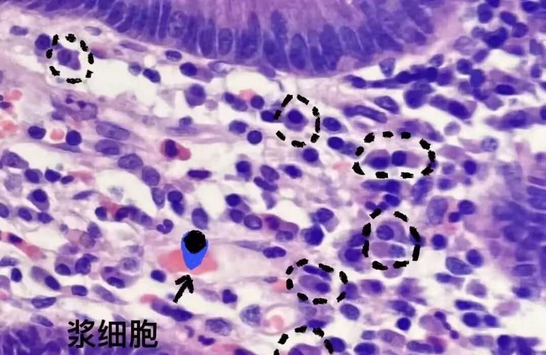 【CKM・疑难寻踪】警惕!腰背痛、骨质疏松,一查竟是血液病!