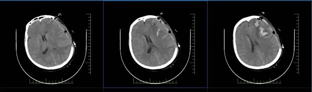 吉林省首例！术后颅骨缺失患者在长春国文医院神经外科完成 4D 「鸟巢」 仿生骨颅骨重建