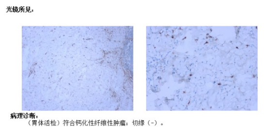 胃里发现隐匿肿物,病理竟是极罕见CFT