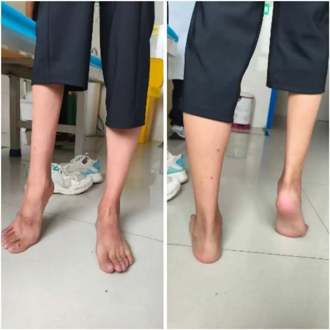 微创环架矫形,让马蹄内翻足患者重获稳健步态 | 河科大二附院关节·创伤外科开展环形固定架微创足部畸形矫形技术