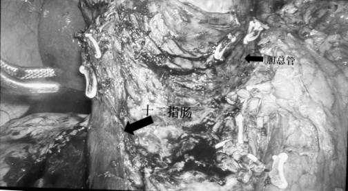 7厘米胰头肿瘤紧贴胆管胰管,35岁女子如何实现器官功能保护?