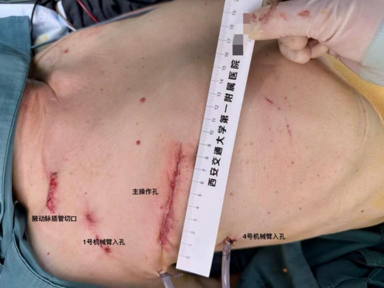 【交医精术】“不开胸”换心脏 西安交大一附院成功实施机器人微创心脏移植手术