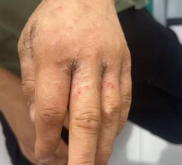 【二附院医生说】睡醒身上多了一串“红包”?当心床虱叮咬