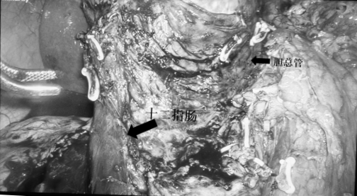 7厘米胰头肿瘤紧贴胆管胰管,35岁女子如何实现器官功能保护?