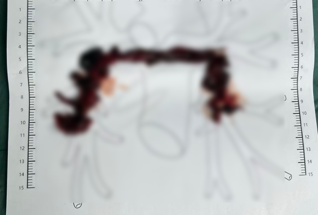 世界血栓日丨胸闷气促8天,心脏里竟藏致命血栓?淮安市一院急性肺栓塞多学科救治团队(PERT)接力两次取栓,生死营救9天