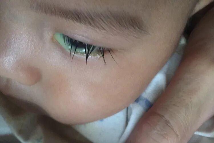 宝宝总是“泪眼汪汪”?当心先天性泪道阻塞!