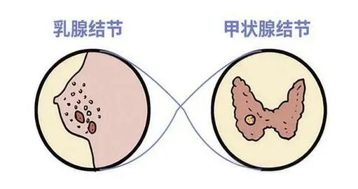 震惊?!它俩竟然是“姐妹”!为啥查出乳腺结节,常常也有甲状腺结节?