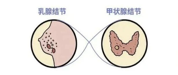 震惊？！它俩竟然是“姐妹”！为啥查出乳腺结节，常常也有甲状腺结节？