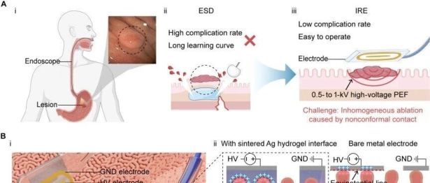 外科梦工场团队提出面向内镜下胃黏膜消融的生物电子—组织界面优化新策略