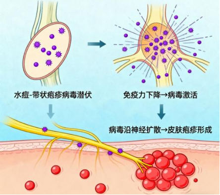 带状疱疹进入高发季:早识别、早就医、早干预