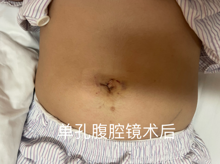 爱美人士了解一下，切口藏肚脐，一文读懂“无痕手术”怎么做