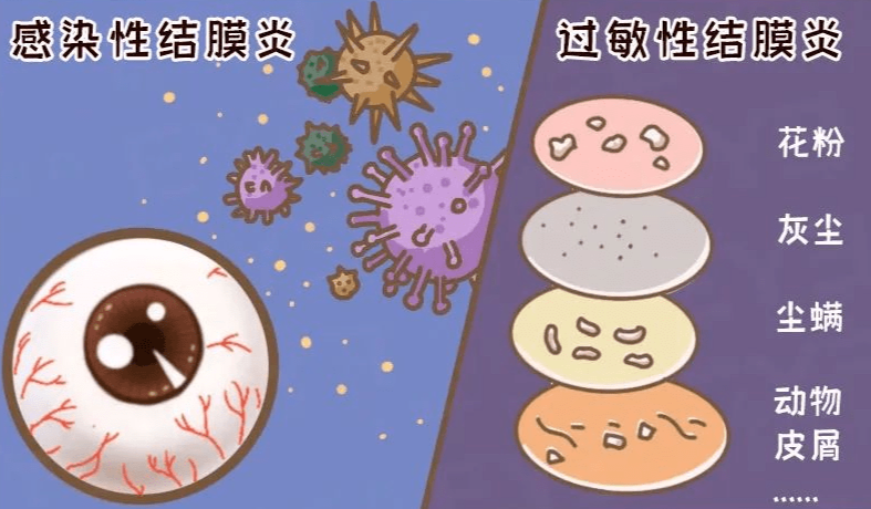 普瑞专家说|眼睛痒到想“抠出来”?换季高发的过敏性结膜炎,别再当“上火”治