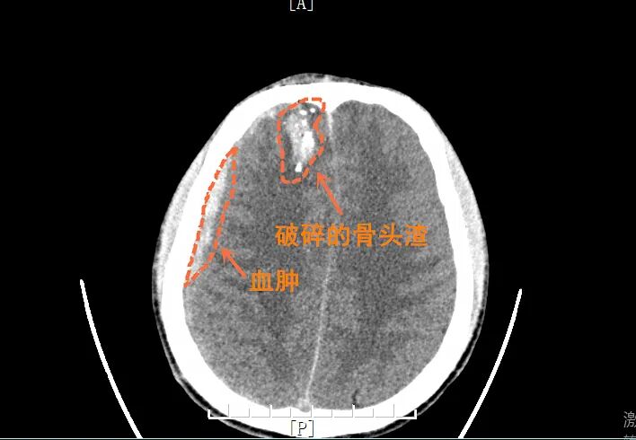 胆小慎入!00后小伙一个动作,反被一“枪”爆头……