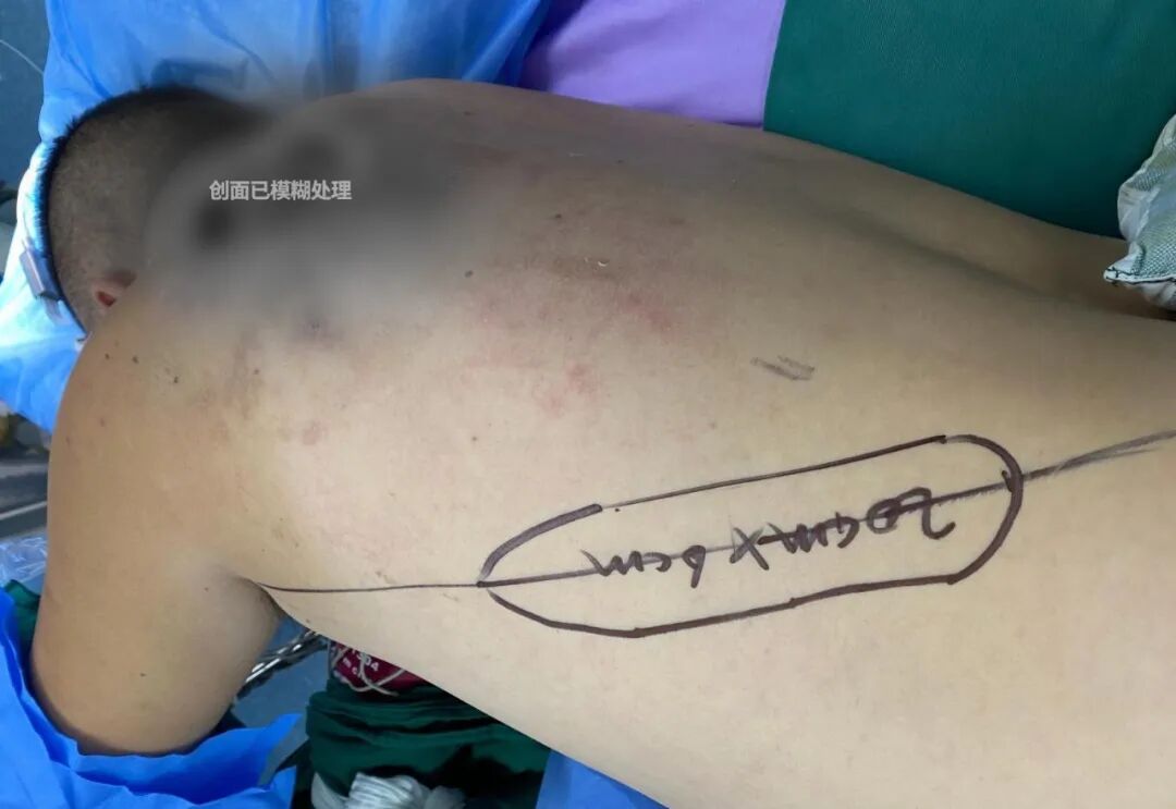 【守护健康】我院骨科神经外科成功运用背阔肌折叠皮瓣,为复杂肩背部巨大肿瘤溃疡患者重塑“生命之壁”