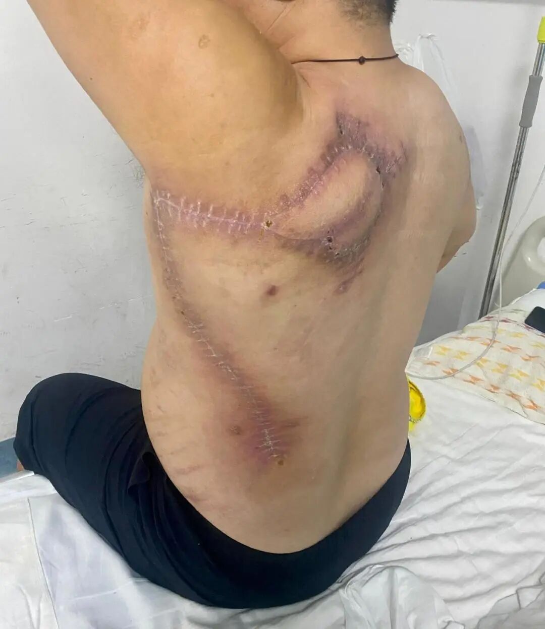 【守护健康】我院骨科神经外科成功运用背阔肌折叠皮瓣,为复杂肩背部巨大肿瘤溃疡患者重塑“生命之壁”