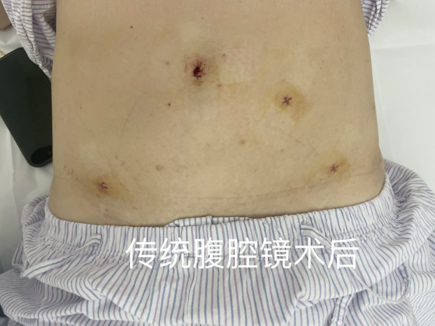 爱美人士了解一下，切口藏肚脐，一文读懂“无痕手术”怎么做