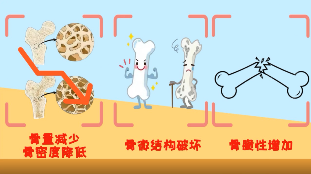 匠心映像·展播 | 骨头太“酥脆”,咳嗽都能骨折?这个“沉默杀手”已经盯上你了