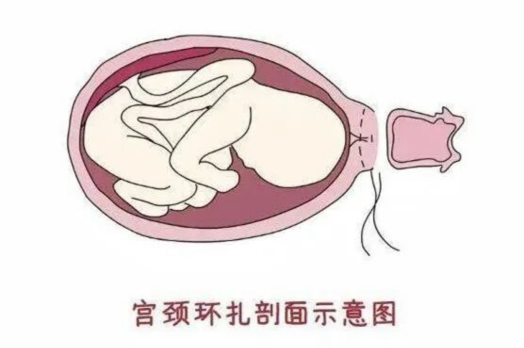 小小的环扎线,托起了她稳稳的幸福:我院产科助宫颈机能不全孕妈顺利分娩