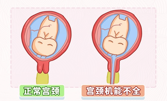小小的环扎线,托起了她稳稳的幸福:我院产科助宫颈机能不全孕妈顺利分娩