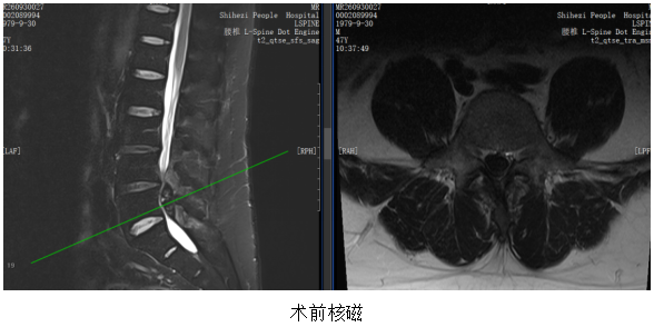 【医疗技术】脊柱内镜“另辟蹊径”，为马尾神经精准“解压”：我院脊柱外科团队完成脊柱内镜下非常规入路治疗椎管内巨大占位性病变