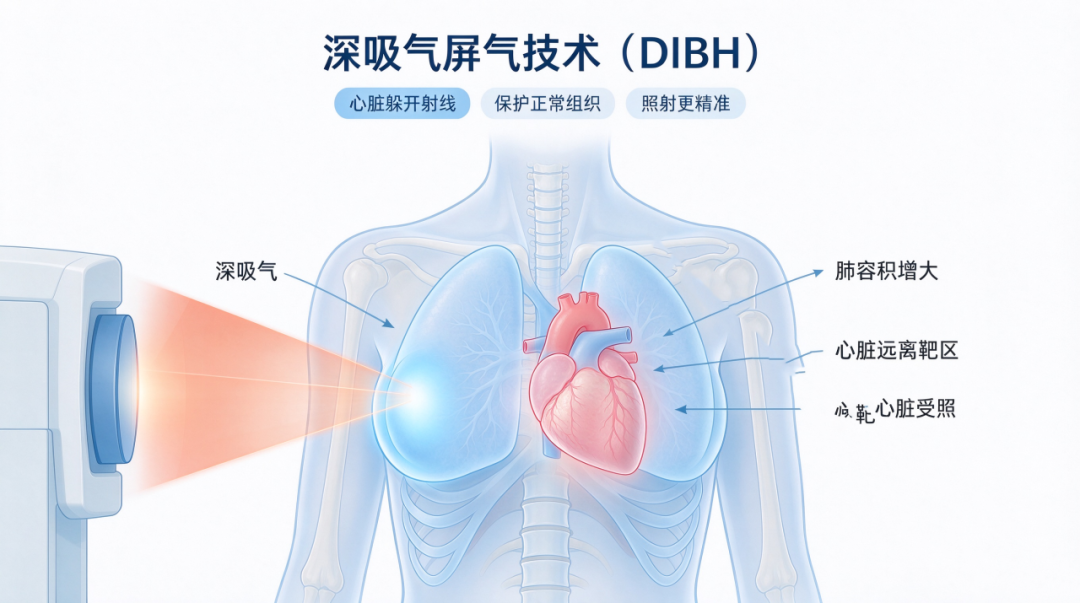 深呼吸 让乳腺癌放疗“不伤心”