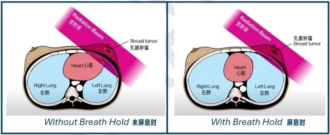 深呼吸 让乳腺癌放疗“不伤心”