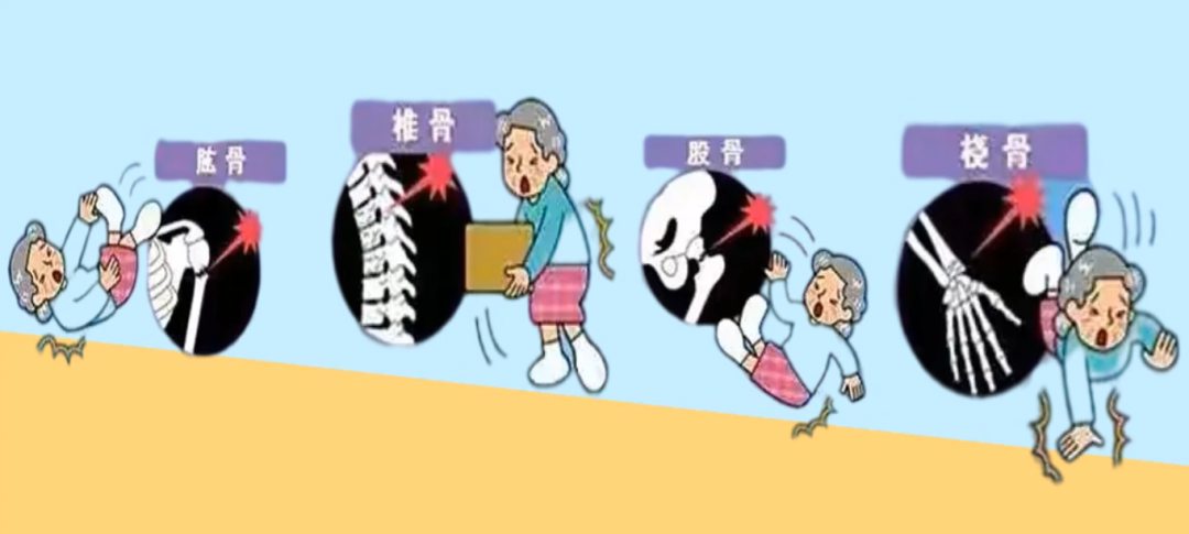 匠心映像·展播 | 骨头太“酥脆”,咳嗽都能骨折?这个“沉默杀手”已经盯上你了