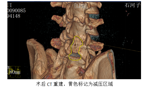 【医疗技术】脊柱内镜“另辟蹊径”，为马尾神经精准“解压”：我院脊柱外科团队完成脊柱内镜下非常规入路治疗椎管内巨大占位性病变