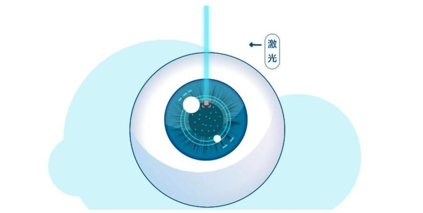 近视手术矫正到多少合适?1.0还是1.2?