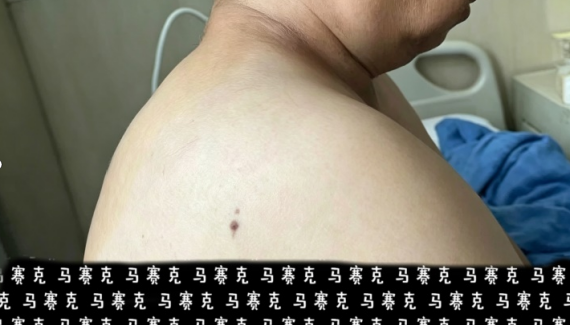 脖子后面长了个包,别以为只是“富贵包”!检查发现另有原因!