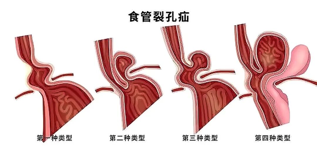 九旬老人胃“移位扭转”辗转求医,荆门市中心医院多学科协作勇闯高龄手术难关