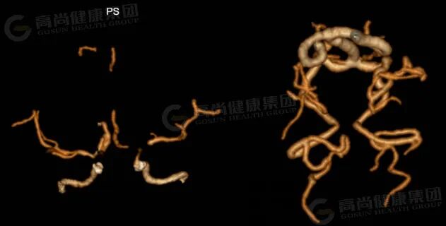 反复脑梗多年查不出原因,一次CTA揪出颅内“烟雾”