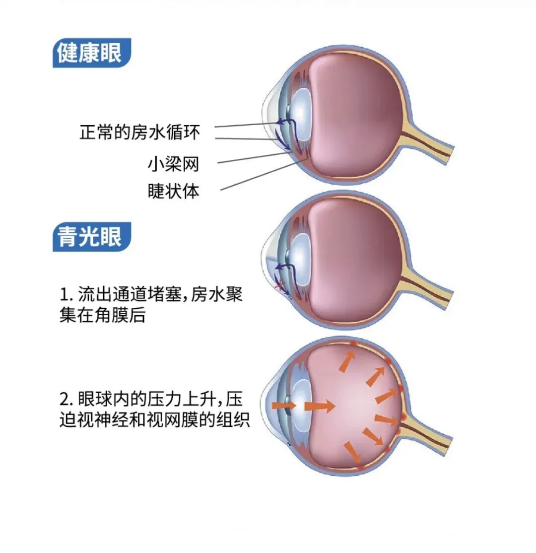 青光眼手术,一定要“开大刀”吗?