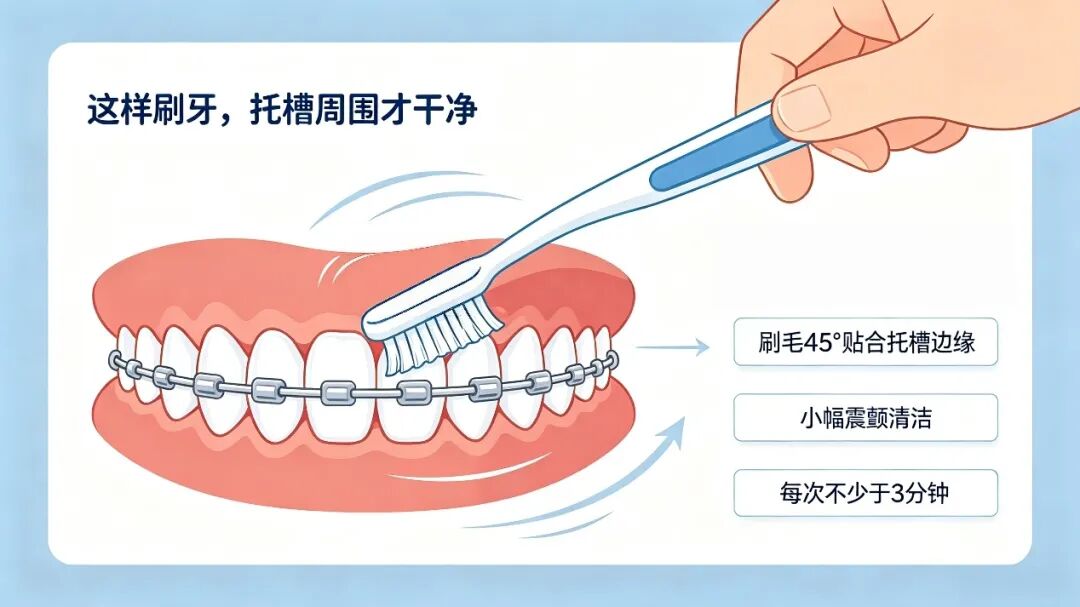 戴固定牙套,口腔卫生千万别忽视!
