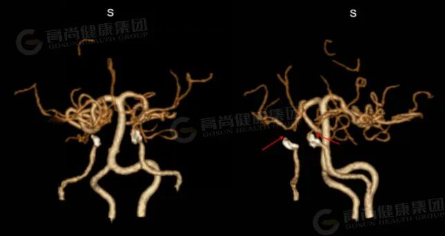 反复脑梗多年查不出原因,一次CTA揪出颅内“烟雾”