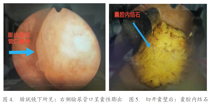 泌尿外科内镜微创“开窗”,一次解决输尿管膨出合并囊内结石
